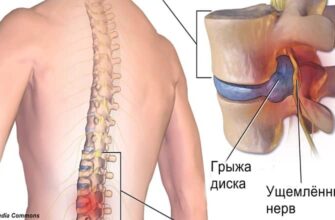 Хирург отговорил меня от операции и посоветовал делать эту зарядку! И ведь помогло!